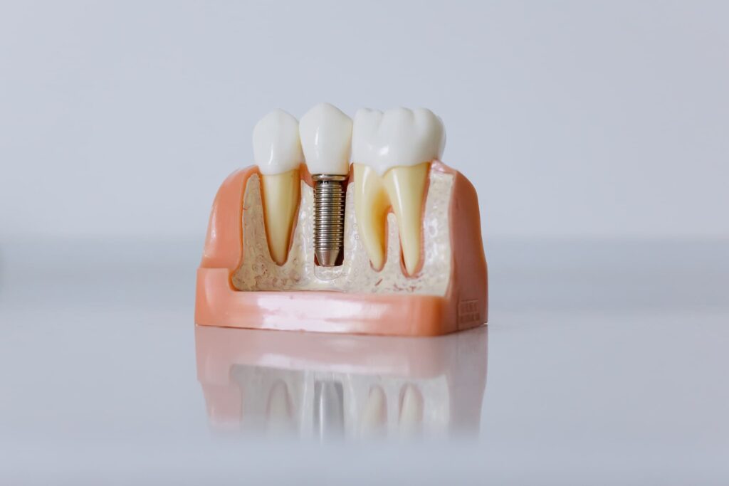 implantes dentales